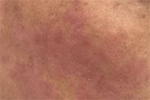 过敏性皮炎 过敏性皮炎