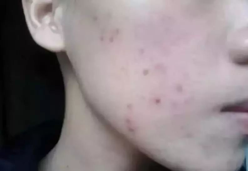 激光治疗痘坑痘印后的护理【厦门广肤皮肤病专科医院】