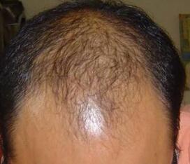 导致严重掉头发的原因都有哪些【厦门广肤皮肤病专科医院】