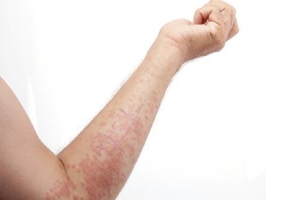 湿疹的预防措施具体是哪些【厦门广肤皮肤病专科医院好不好】