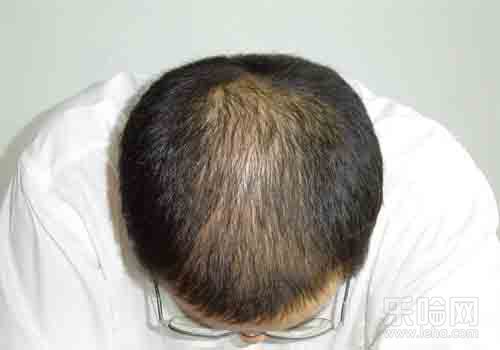脂溢性脱发症状的介绍【厦门广肤皮肤病医院】