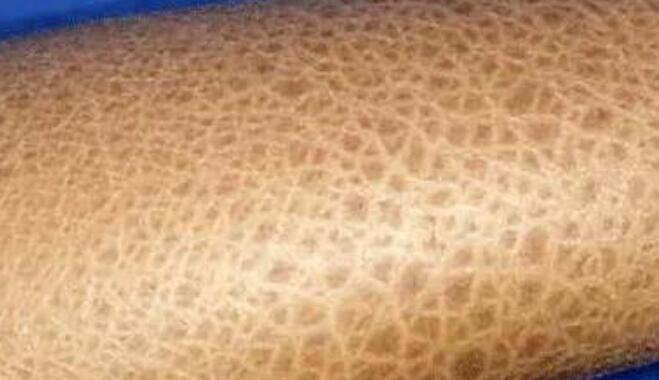 厦门鱼鳞病医院:鱼鳞病的饮食忌口【厦门广肤皮肤病专科医院】