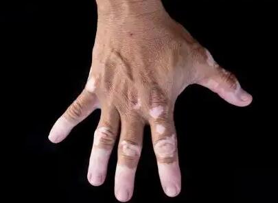 患上了白癜风该如何护理【厦门广肤皮肤病专科】