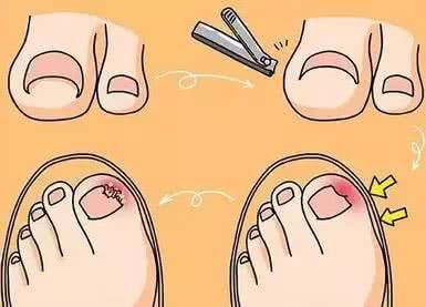 如何预防甲沟炎【厦门广肤皮肤病专科】