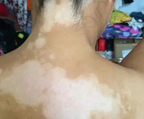 白癜风可怕吗【厦门广肤皮肤病专科医院】